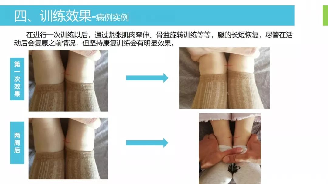 科学认识长短腿