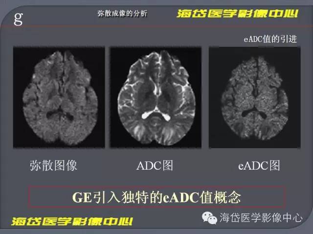 磁共振dwi弥散图像的分析
