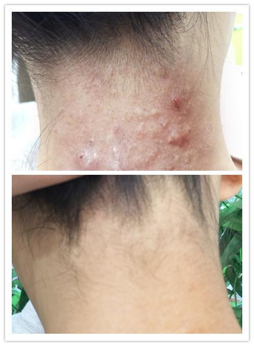 我的毛囊炎用外洗加涂抹的中药方好了分享经验希望对大家有用