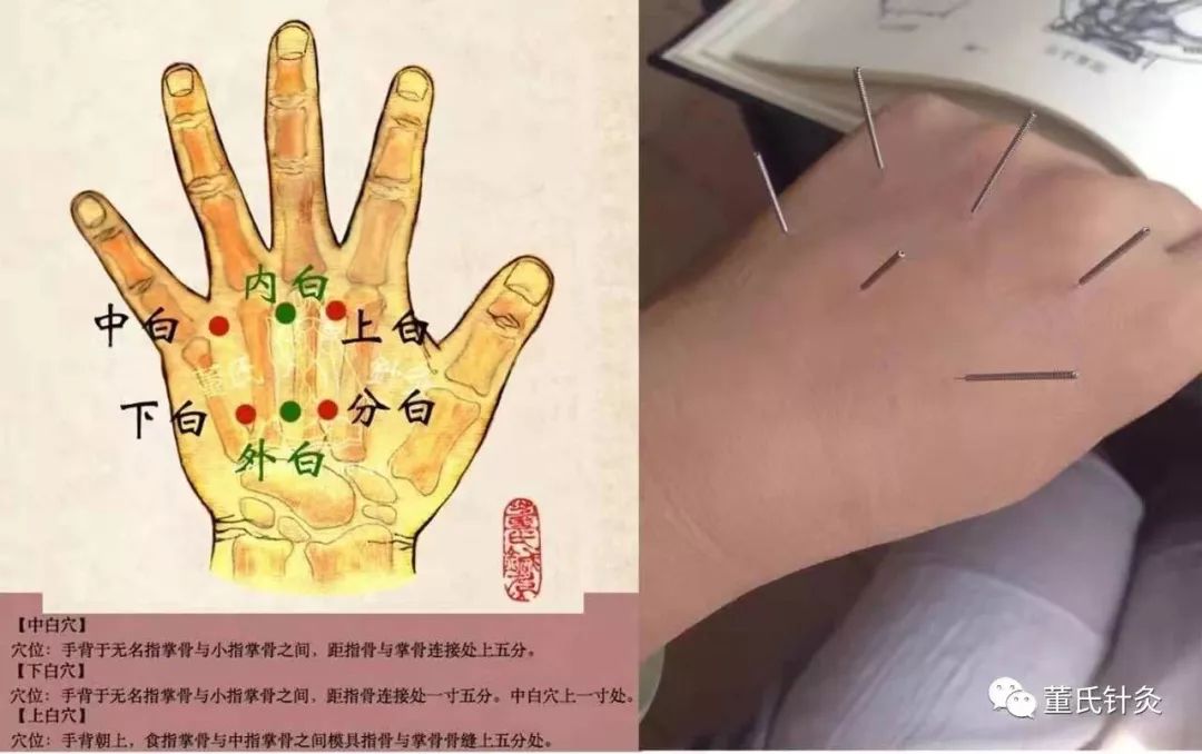 董氏针灸林正泰案例分享之坐骨神经痛处方穴-搜狐大视野-搜狐新闻