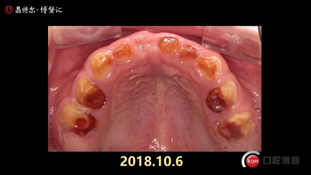 少儿乳光牙全口预成冠修复