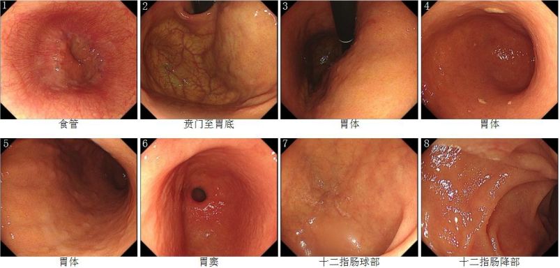 胃窦,胃角,胃体,贲门黏膜稍充血,粗糙,胃体大弯侧黏膜皱襞变细,胃底