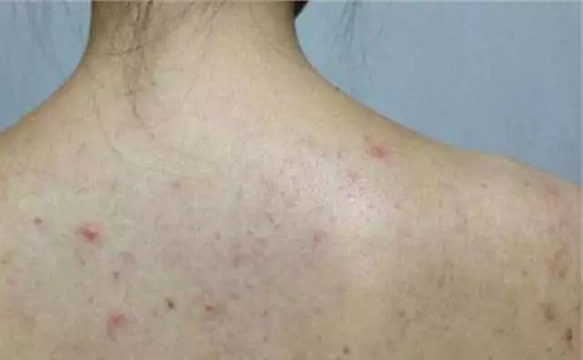 也有可能是慢性皮肤病造成的,通常被唤做脂溢性皮炎,严重的话可能