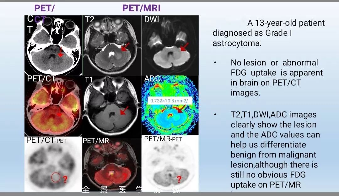 18ffdgpetmr與petct在兒童腫瘤診斷中的初步對比研究