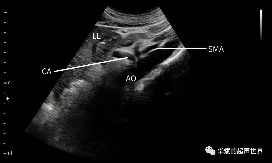 ll:左肝;sma:肠系膜上动脉;ao:腹主动脉;ca:腹腔动脉.