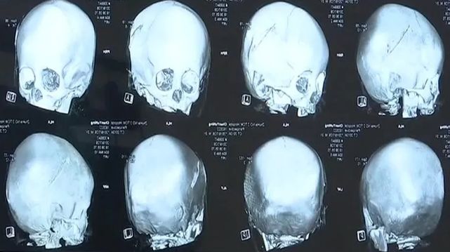 心痛!3岁女童被爸爸举高高,结果颅骨粉碎性骨折