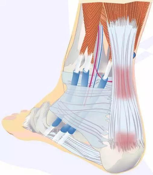 微信運動超過2萬步的要注意了跟腱疼痛跟腱炎會找到你