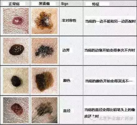胸无大痣未必不是好事