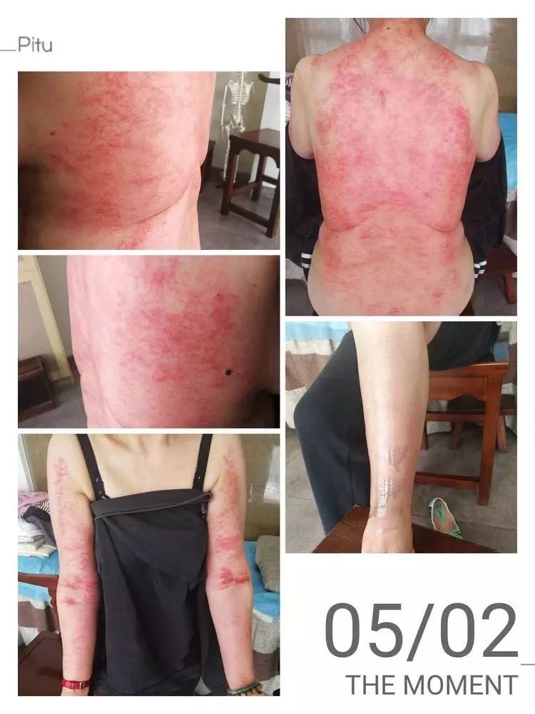 刮痧的过程中,了解到患者近期工作压力大.