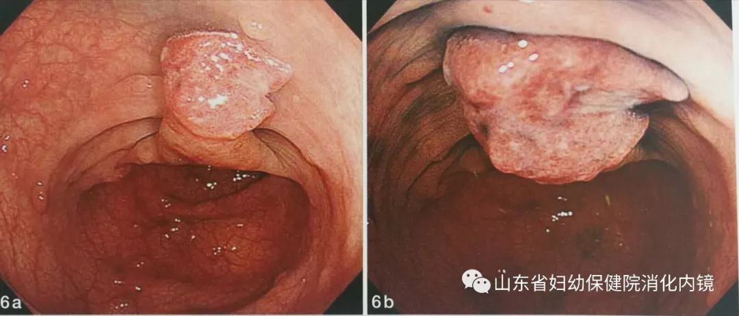 8歲孩子被查出結腸癌前病變!出現這些症狀,家長們千千萬要注意啦!