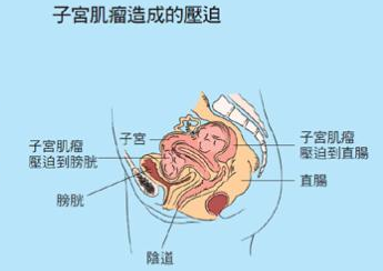 子宫后壁在哪里图片图片