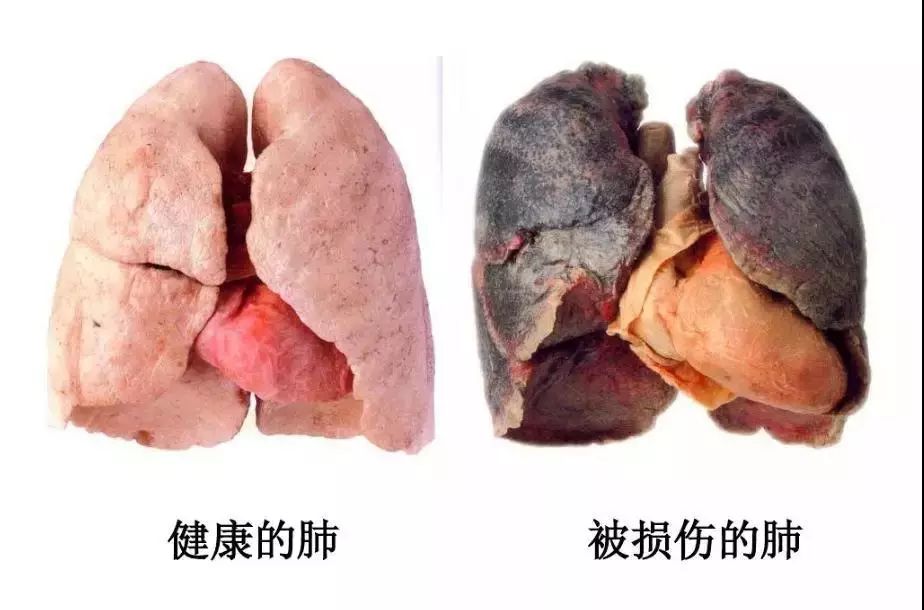 呼吸道粘膜和肺脏被病毒侵蚀了,再用昂贵进口药,做动辄上万的洗肺手术