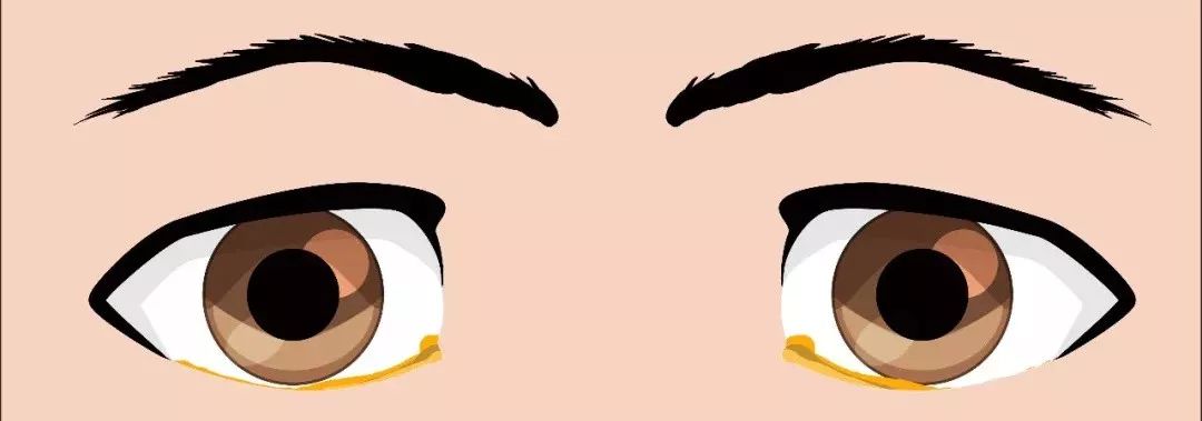 二,粘性黄色分泌物眼睛中经常有白色胶状物质,不光出现在眼角,眼球上