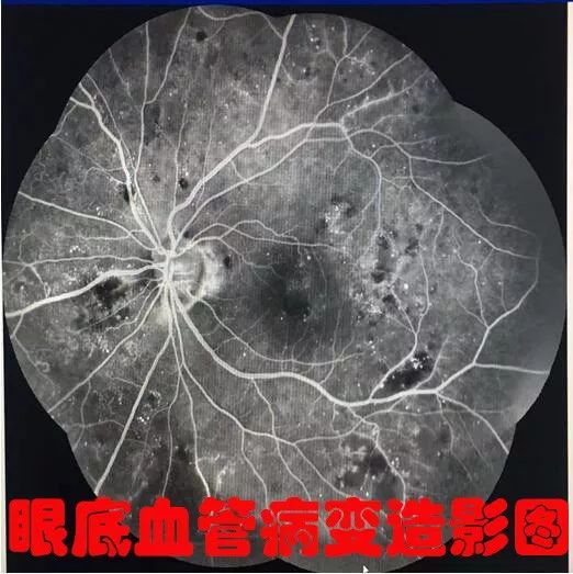 成年人眼部视力下降的隐形杀手糖尿病性视网膜病变