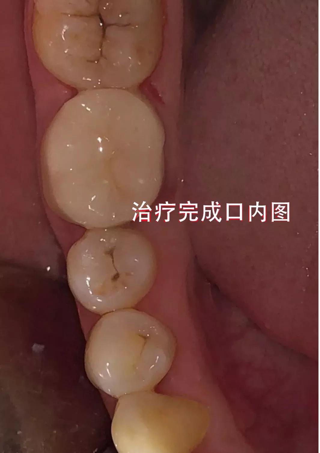 河源市人民医院网站-口腔科开展首例显微镜下治疗内漂白微创修复着色牙，还原漂亮牙齿