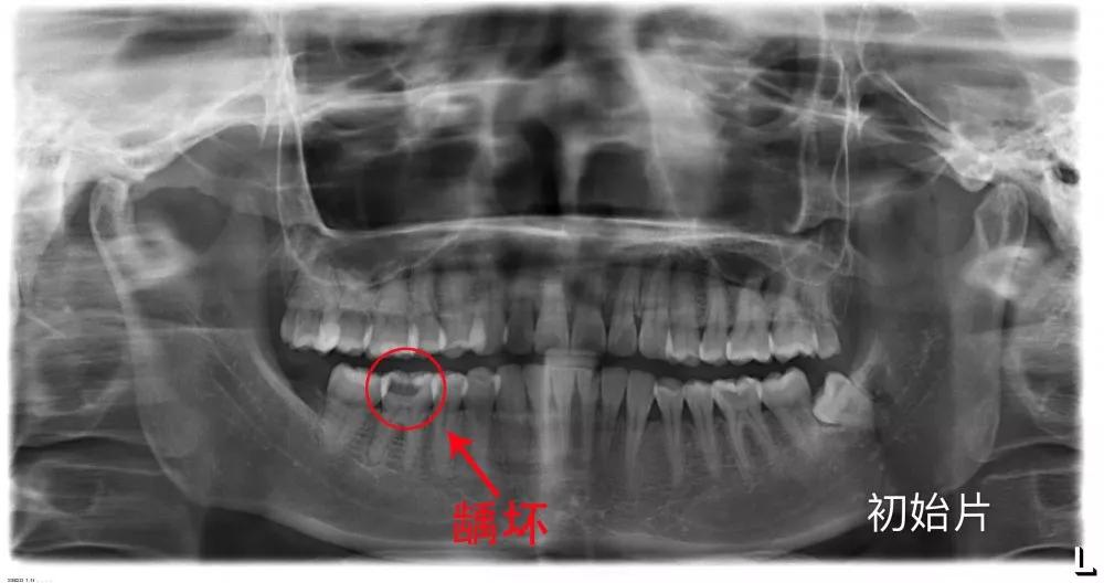 牙髓炎x光片表现图片