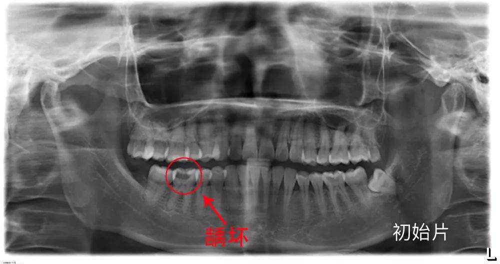 牙髓炎x光片图片