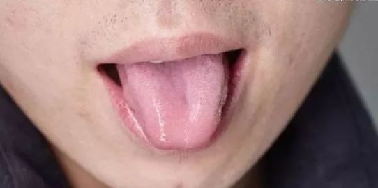 癌症舌苔图片