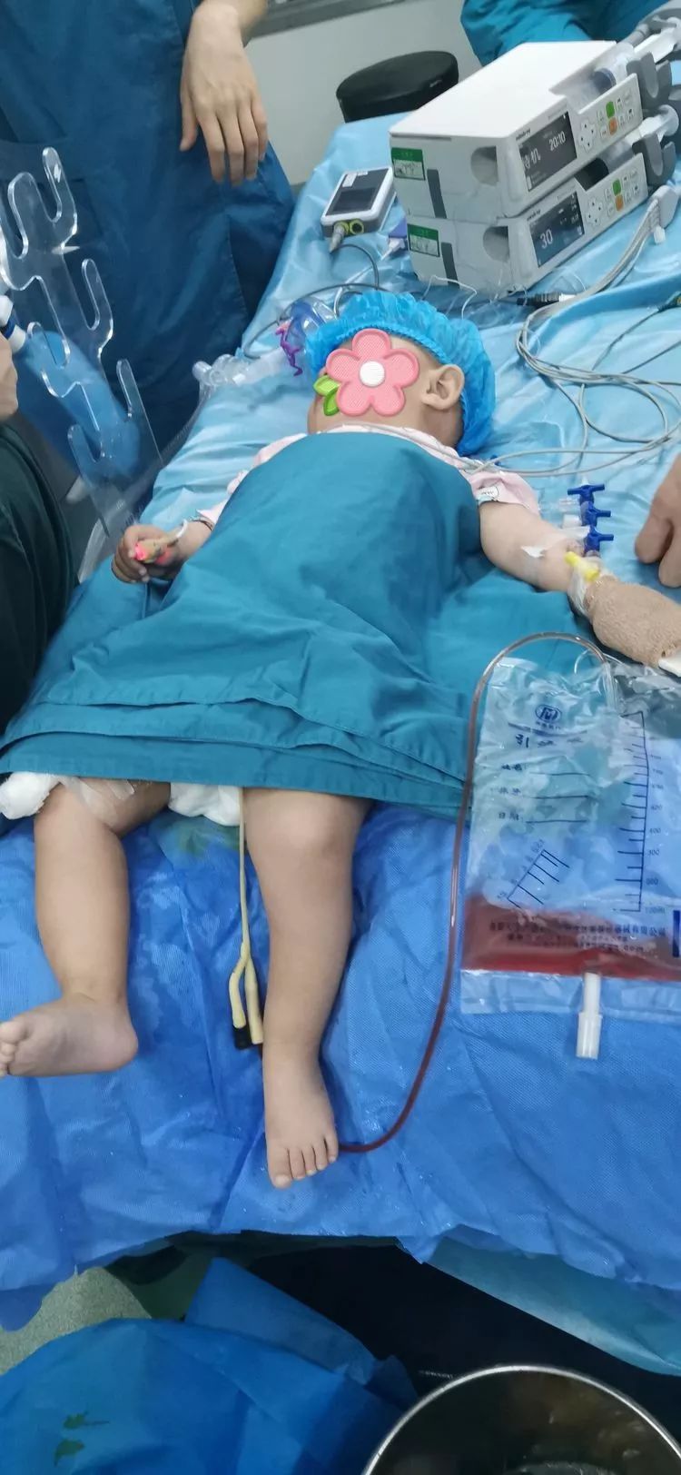 硬实力我院泌尿外科成功为8个月大婴儿实施双侧输尿管结石碎石术