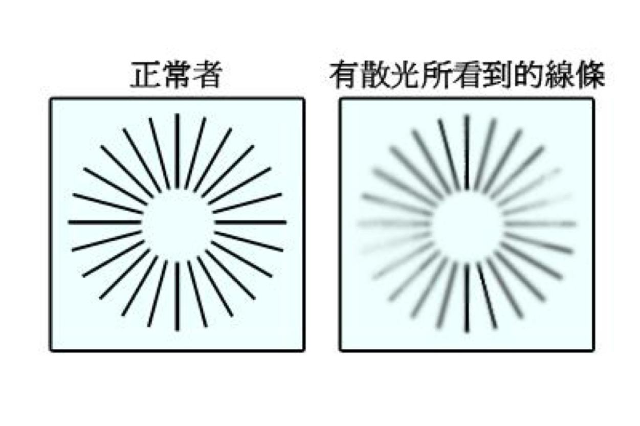 頭位和眼位異常雙眼有高度不對稱散光者,為了看清楚物體,往往採取傾斜