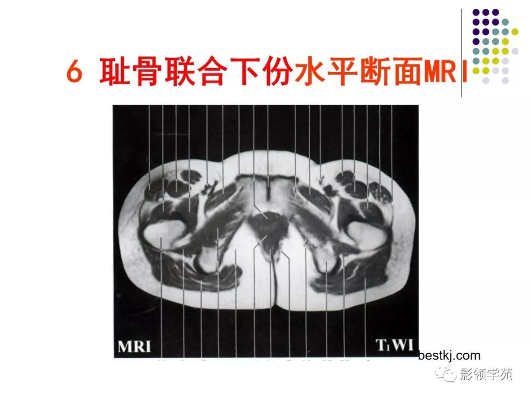 骨盆CT解剖影像图片