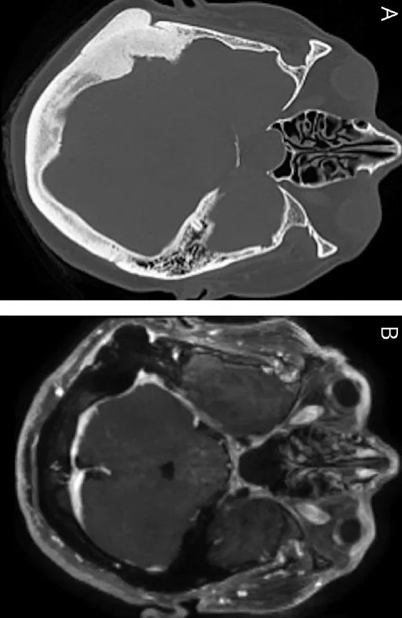 头 mri 显示空蝶鞍(下图 1a),双侧视神经萎缩(下图1b),乳突骨瘤