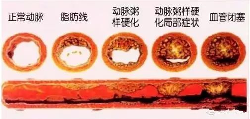 不同的血管堵塞會引發不同的疾病,別等躺在病床上再重視!