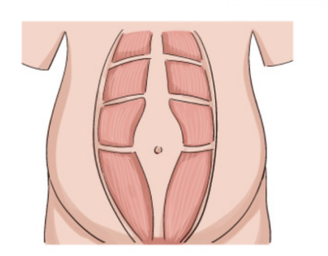 (正常腹直肌)妊娠晚期,增大的子宫会使腹壁扩张延伸,腹直肌会从腹中线