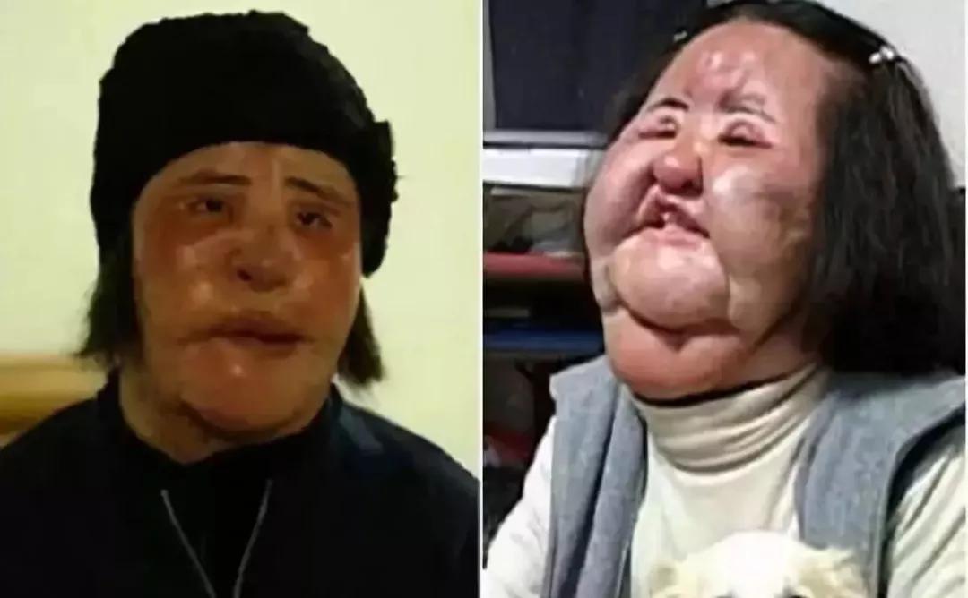 相亲两次彩礼被退,后因长相离婚,为再婚男子花巨款整了五个项目!_程源