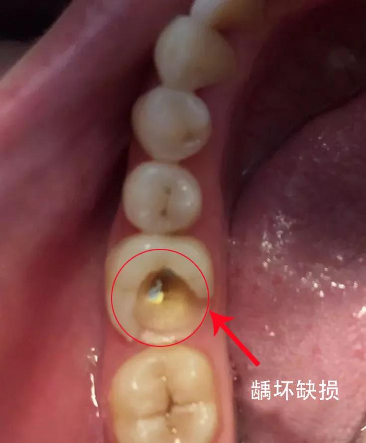 门牙牙髓炎图片