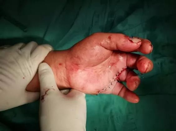 骨科专家施妙手断指再植技艺高