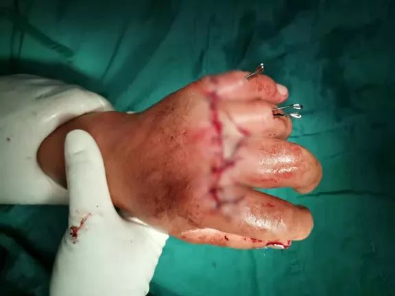 骨科专家施妙手断指再植技艺高