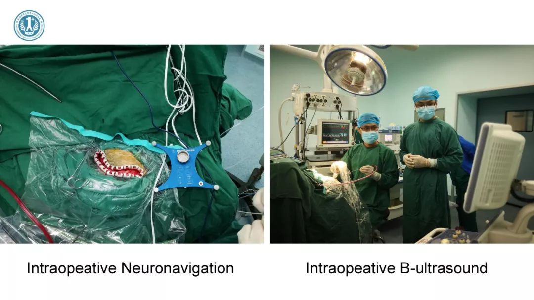 李庆新医师:一例快速进展型胶质母细胞瘤的规范化及精准治疗分析