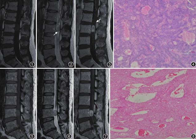 病例报告椎管内原发副神经节瘤影像表现二例