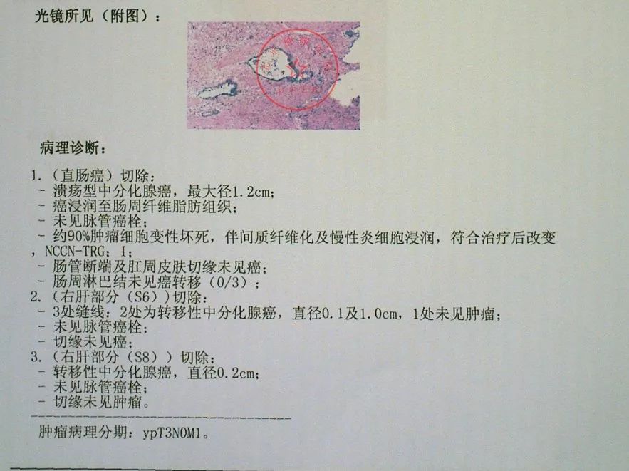 结直肠癌合并肝转移手术否大咖经验倾囊相授