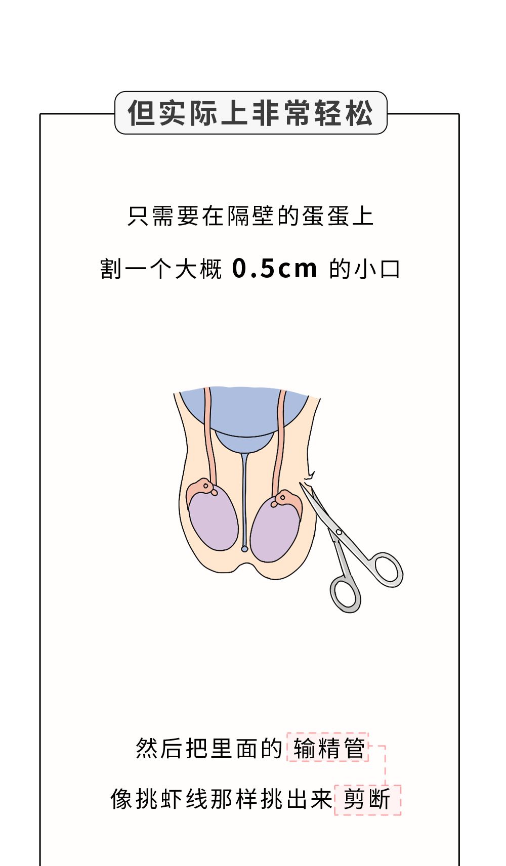 你願意為女朋友做結紮手術嗎