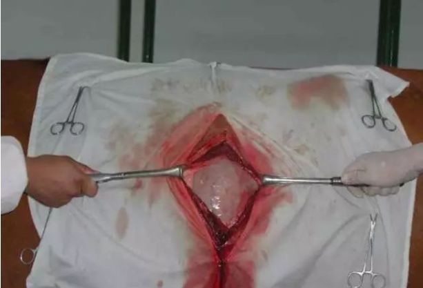 手把手教你瘤胃切开术全图文