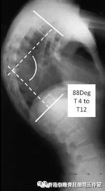 脊柱後凸畸形-休門氏症_段後