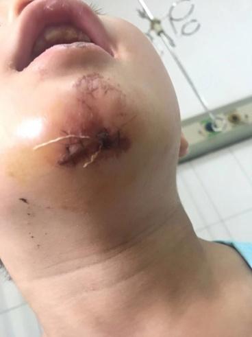 谁该承担责任菏泽交通未来城小区内被临时管道绊倒孩子受伤