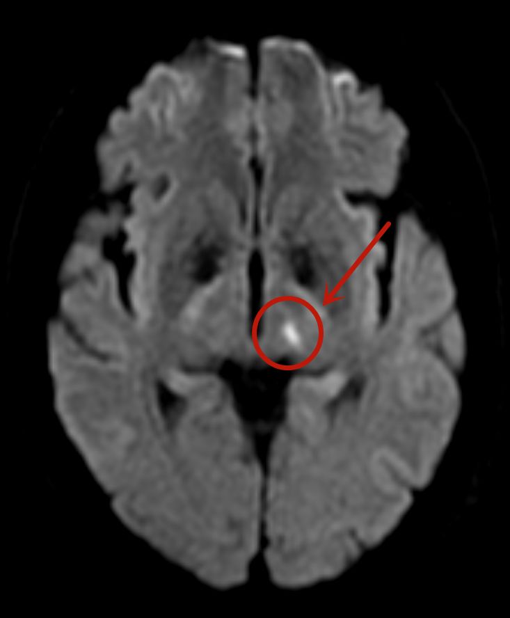 颅脑核磁共振结果很快出来,诊断童女士为双侧放射冠区,半卵圆中心及