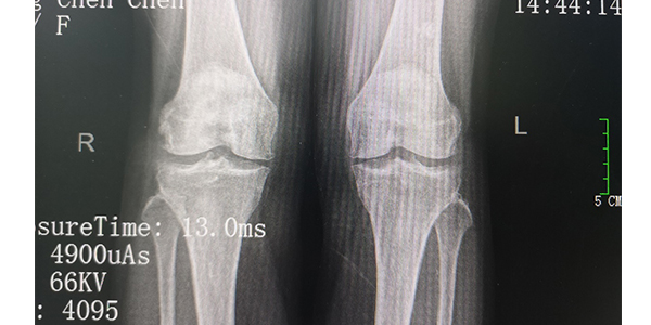 内热针疗法在保膝治疗中的临床应用