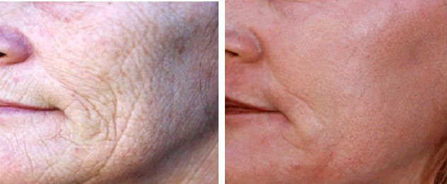 德国全能点阵铒激光欧美医疗整形美容诊所必备