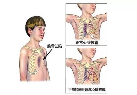 5岁宝宝正常乳房图片