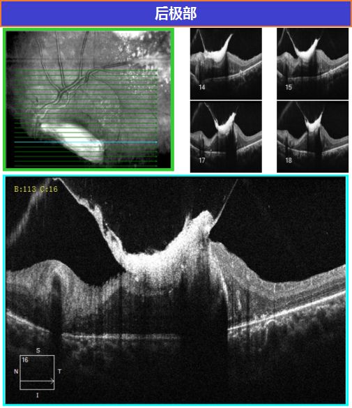 每周最佳病例分享极限挑战coats病