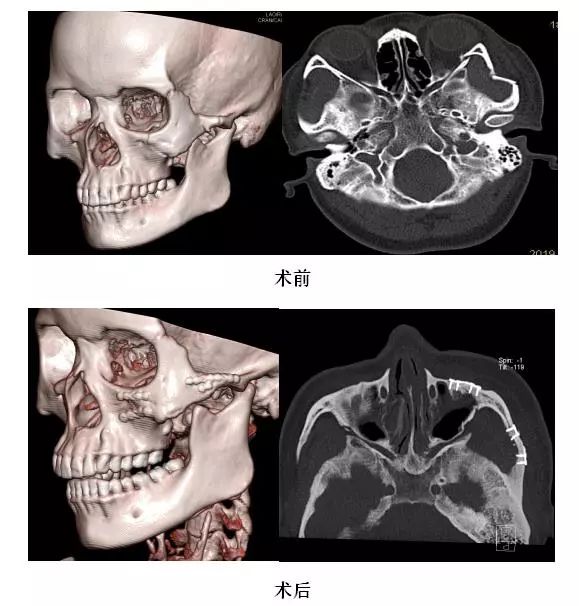我院口腔科成功开展三切口联合入路颧骨颧弓多发骨折复位固定术