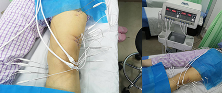 内热针疗法在保膝治疗中的临床应用_膝关节