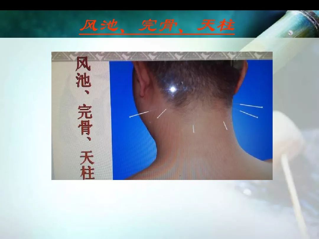 石学敏醒脑开窍治疗中风