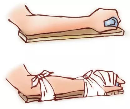 【救援知识】骨折固定,最基础的现场固定技术_夹板