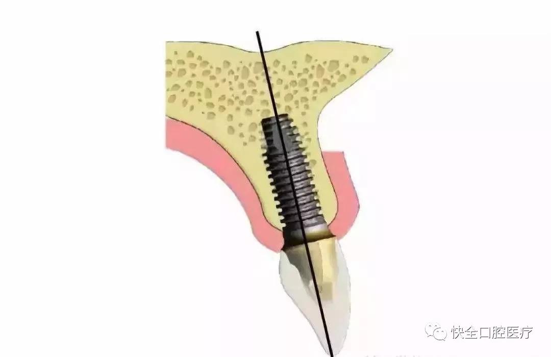 种植体的中心位于冠切端的下方,这样在切缘下可以使用直基台粘接固位.