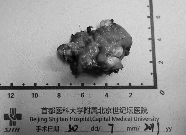 八个科室十几位专家接力,北京医生勇闯"手术禁区"_恶性肿瘤